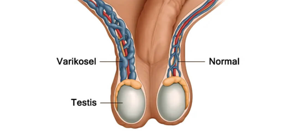Varikosel ve Normal Testis Damar Yapısı Karşılaştırması
